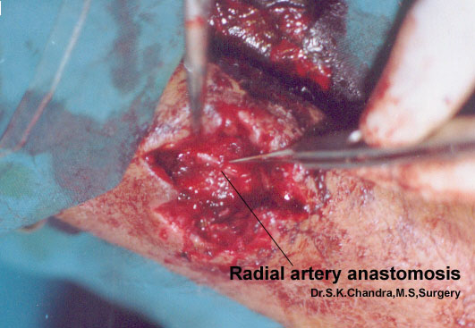 Radial Artery Repair